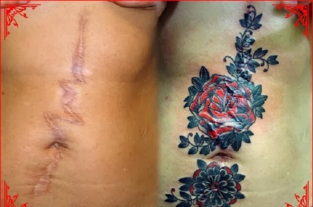 Tatouages cache cicatrices