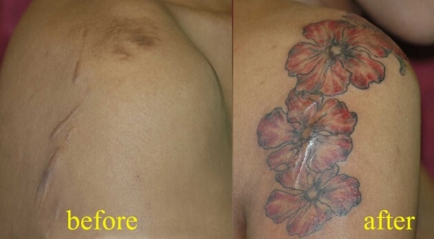 Tatouages cache cicatrices