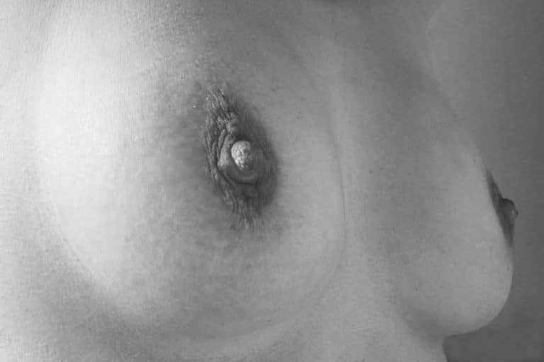 Des symptômes inhabituels du cancer du sein qu’il ne faut pas ignorer